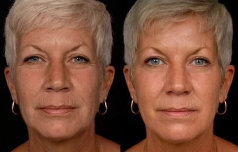 Das Ergebnis der Laserbehandlung der Gesichtshaut Faltenreduzierung. 