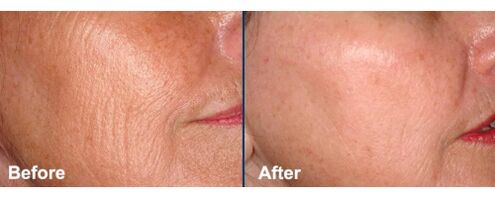 Gesichtshaut vor und nach dem Laser-Resurfacing-Verfahren. 