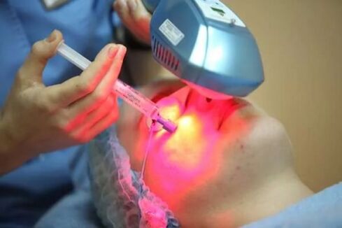 Laser-Biorevitalisierung der Gesichtshaut. 