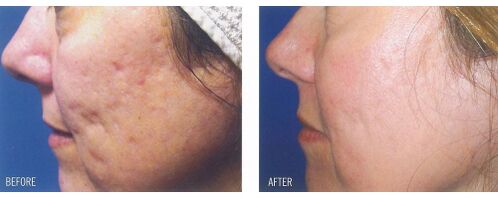 Vor und nach der Anwendung des Lasergeräts auf vernarbter Haut. 